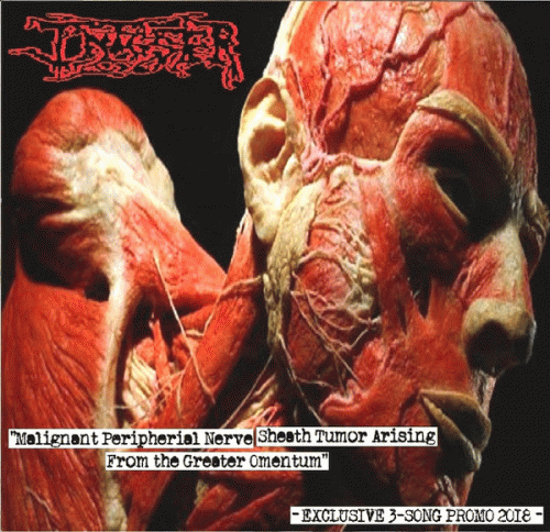 Infester (USA-2) : Malignant Peripherial Nerve Sheath Tumor Arising from the Greater Omentum